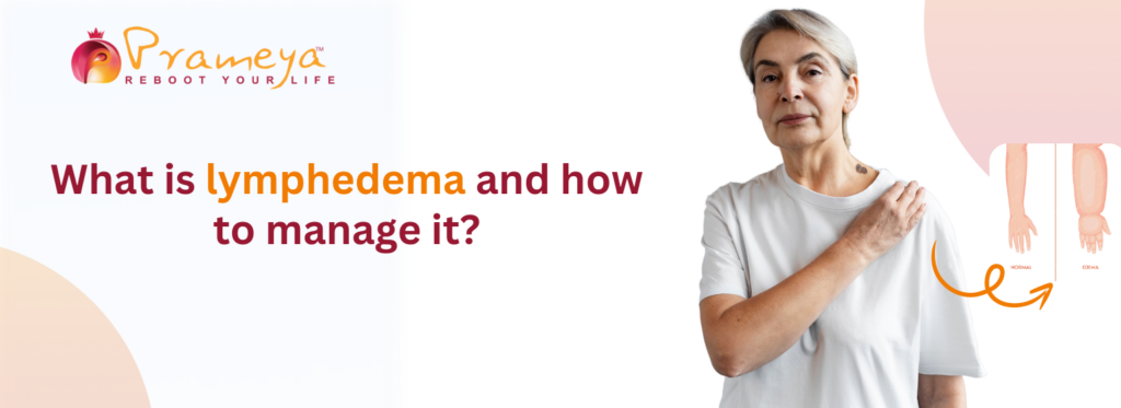 What is lymphedema and how to manage it?
