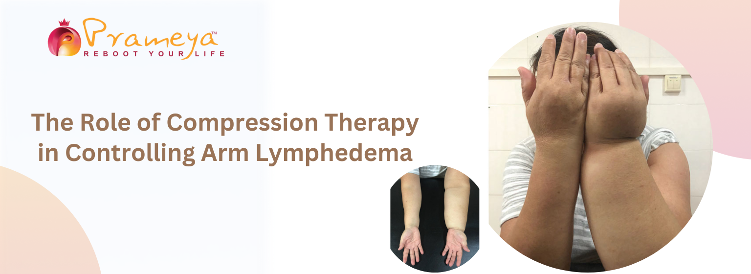 The Role of Compression Therapy in Controlling Arm Lymphedema